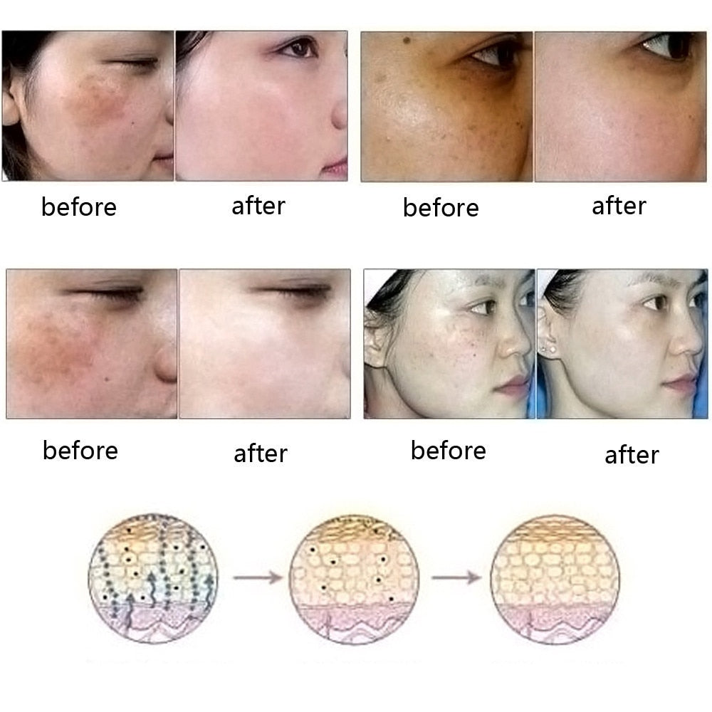 Dredge Meridian Skin Care Natural Pure Removal Acne Stretch Marks Scar Removal Essence oil null